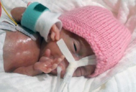 Meet the world`s smallest baby after being born weighing 8 ounces 